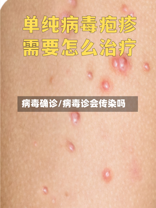 病毒确诊/病毒诊会传染吗