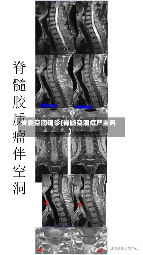 脊髓空洞确诊(脊髓空洞症严重吗)