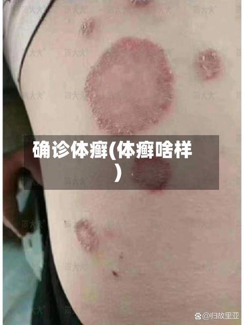 确诊体癣(体癣啥样)-第2张图片