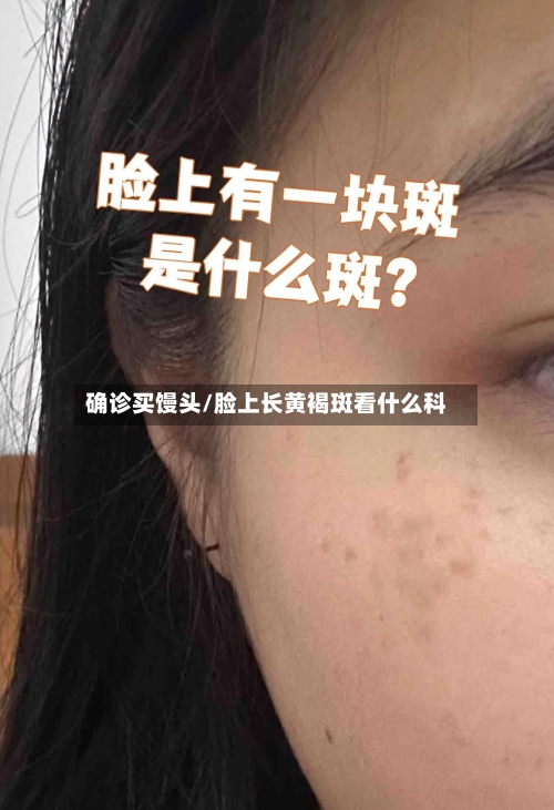 确诊买馒头/脸上长黄褐斑看什么科-第2张图片