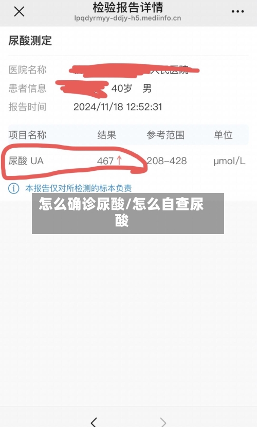 怎么确诊尿酸/怎么自查尿酸