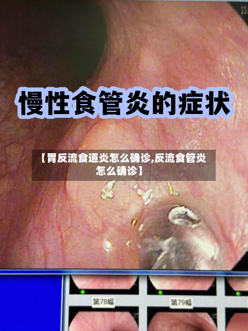 【胃反流食道炎怎么确诊,反流食管炎怎么确诊】