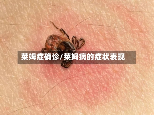 莱姆症确诊/莱姆病的症状表现