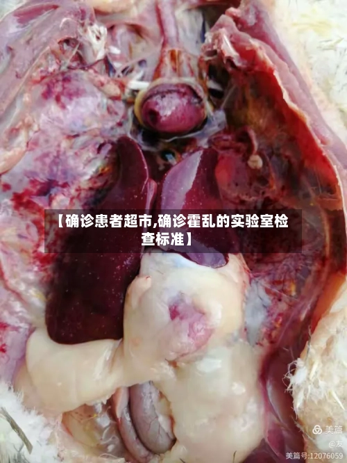 【确诊患者超市,确诊霍乱的实验室检查标准】-第3张图片