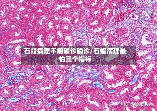 石蜡病理不能确诊确诊/石蜡病理最怕三个指标