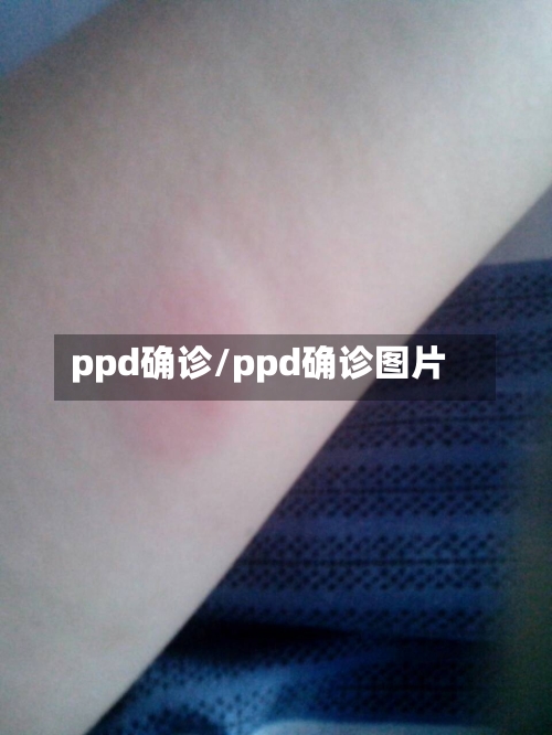 ppd确诊/ppd确诊图片-第2张图片