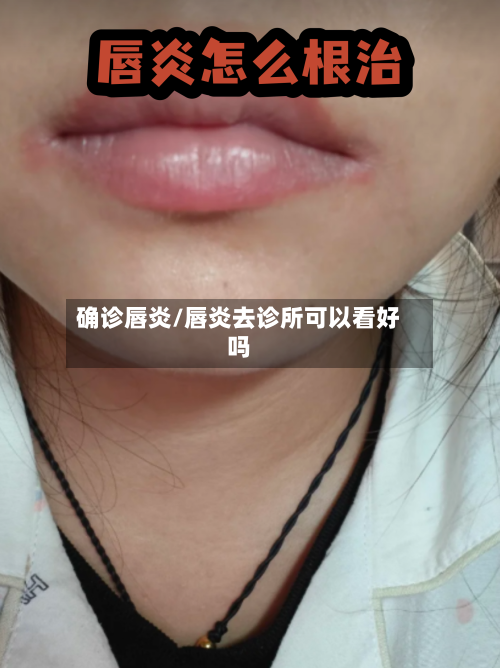 确诊唇炎/唇炎去诊所可以看好吗