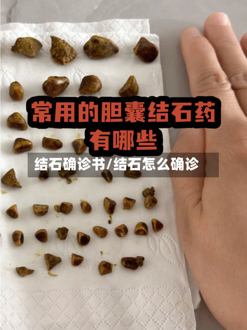 结石确诊书/结石怎么确诊