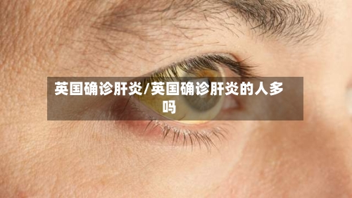 英国确诊肝炎/英国确诊肝炎的人多吗-第2张图片