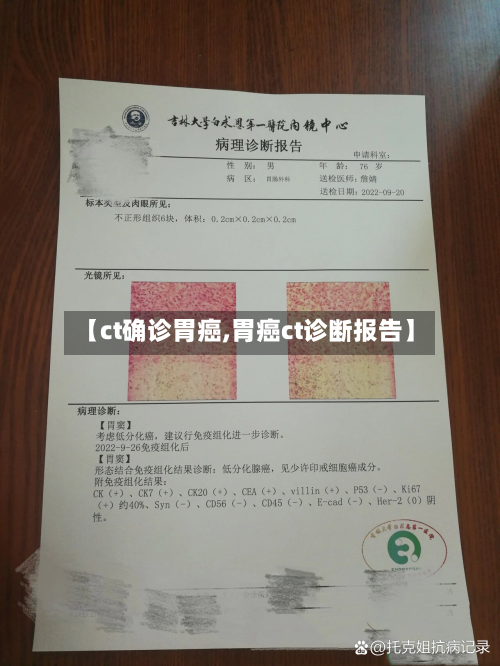 【ct确诊胃癌,胃癌ct诊断报告】-第3张图片