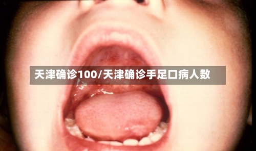 天津确诊100/天津确诊手足口病人数