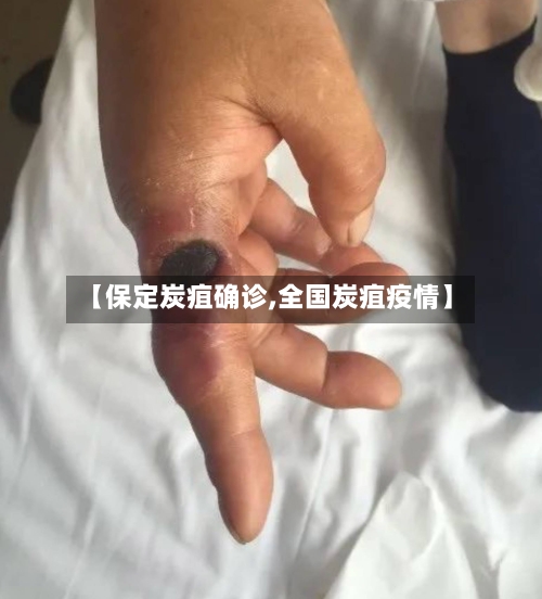 【保定炭疽确诊,全国炭疽疫情】