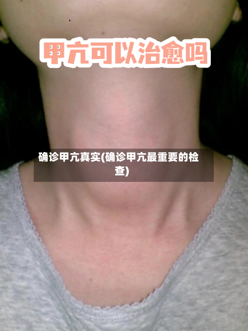 确诊甲亢真实(确诊甲亢最重要的检查)-第2张图片