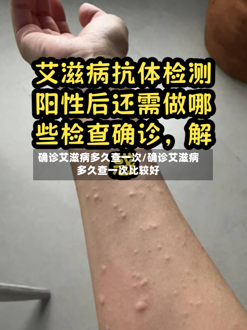 确诊艾滋病多久查一次/确诊艾滋病多久查一次比较好