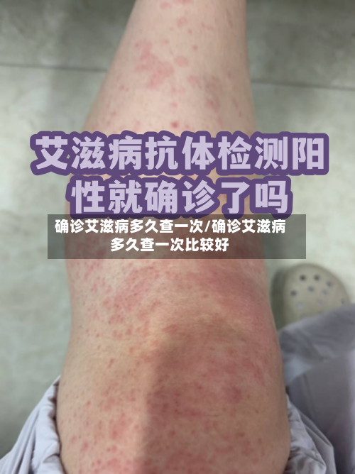 确诊艾滋病多久查一次/确诊艾滋病多久查一次比较好-第2张图片
