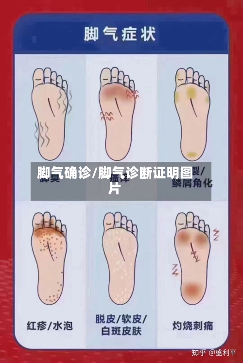 脚气确诊/脚气诊断证明图片-第2张图片