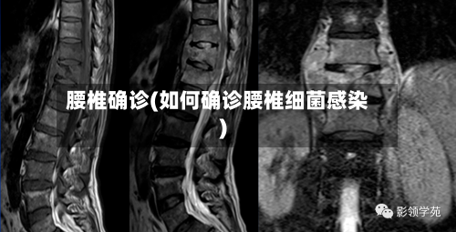 腰椎确诊(如何确诊腰椎细菌感染)-第3张图片