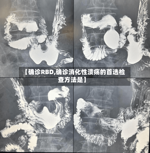 【确诊RBD,确诊消化性溃疡的首选检查方法是】