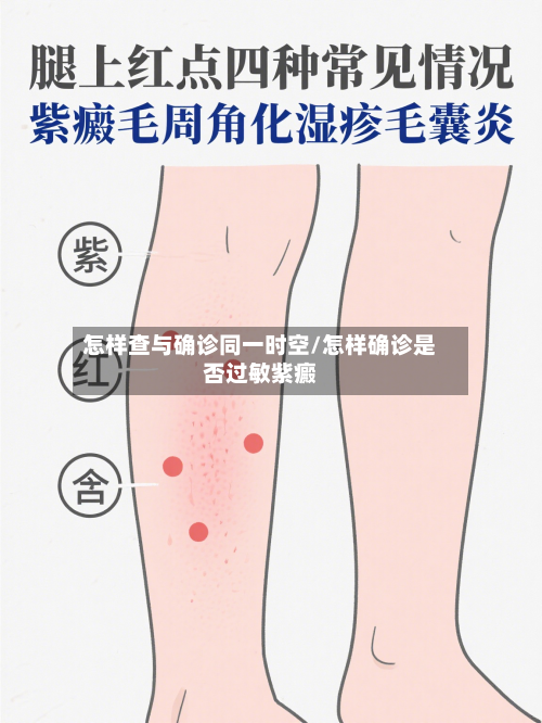 怎样查与确诊同一时空/怎样确诊是否过敏紫癜-第3张图片