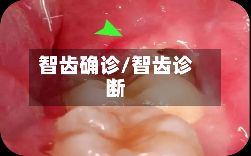 智齿确诊/智齿诊断