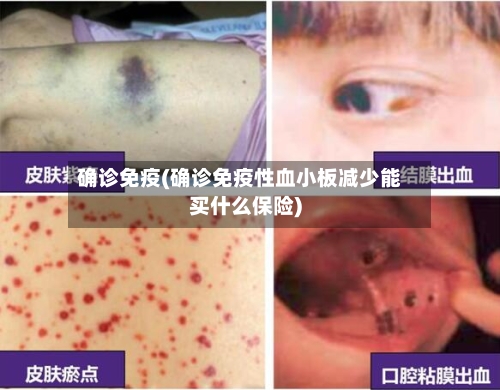 确诊免疫(确诊免疫性血小板减少能买什么保险)-第3张图片