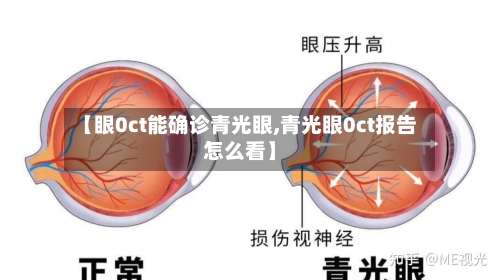 【眼0ct能确诊青光眼,青光眼0ct报告怎么看】