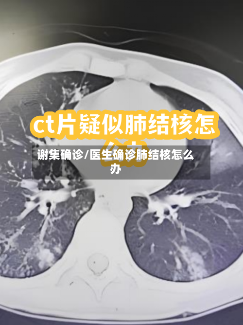 谢集确诊/医生确诊肺结核怎么办-第2张图片