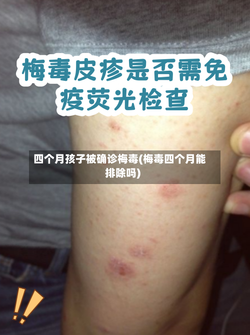 四个月孩子被确诊梅毒(梅毒四个月能排除吗)